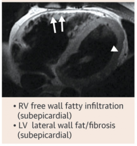 図2　脂肪抑制なしのT1画像による右室壁・左室壁の心外膜側からの脂肪変性　 文献[9]より部分引用