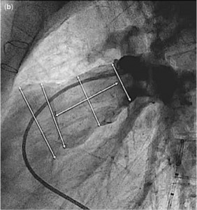 RVOT L