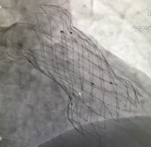 Stent Fracture症例