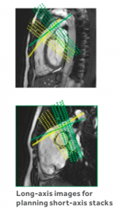 右室流出路の心拍変動