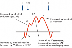 Associated factors of PV flow