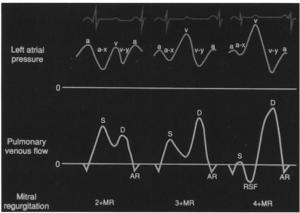 PV flow of MR